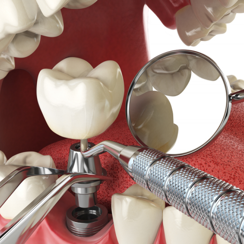 Cấy ghép Implant